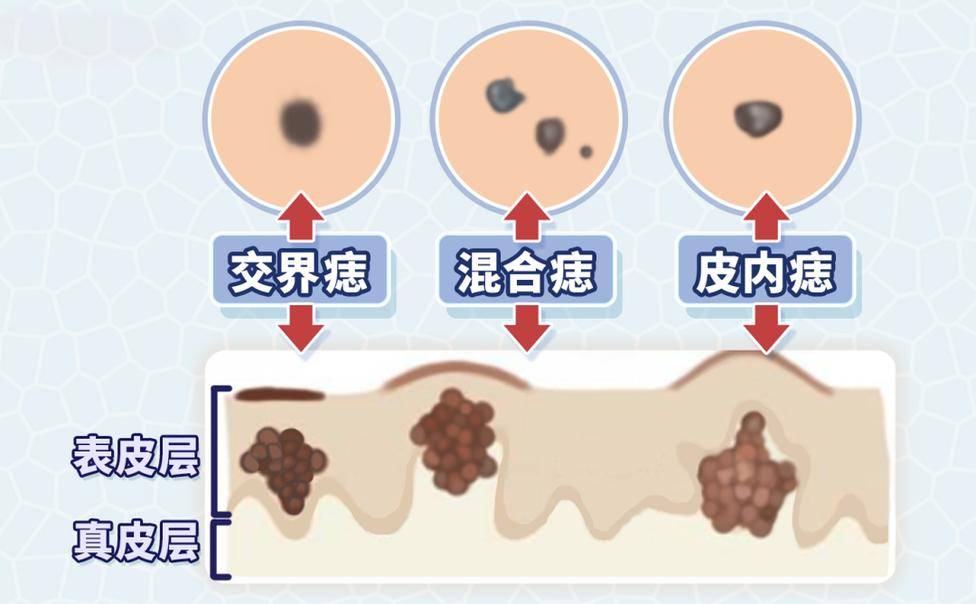 沈阳肤康带你了解疣状痣_治疗_li_患者