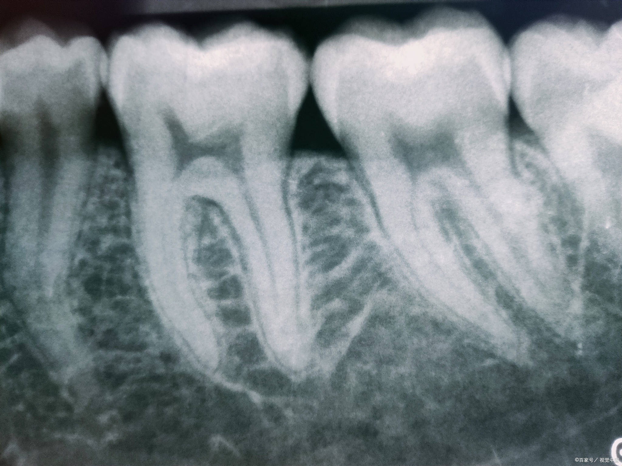 通过牙片,医生可以观察到智齿的形态和牙根生长方向,以及智齿的牙根与