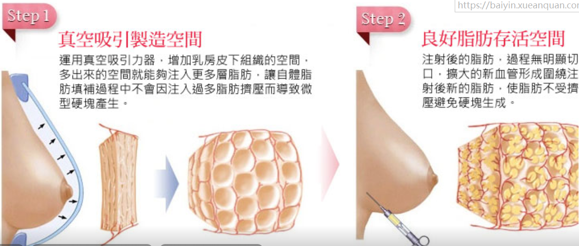 自体脂肪丰胸经历亲身:听听过来人自体脂肪隆胸忠告