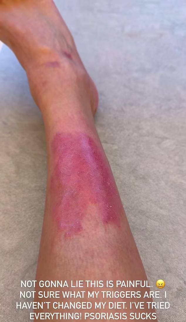 金·卡戴珊晒腿上牛皮癣,红色疤痕触目惊心,治疗十多年仍无果_疾病