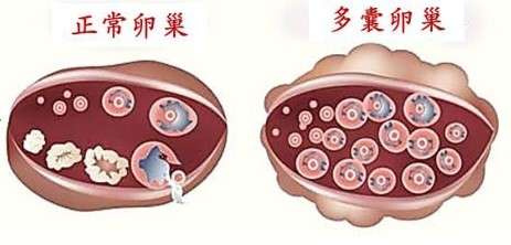 上海第十人民医院戴雪医生:多囊人群为什么容易流产?_患者_风险_治疗