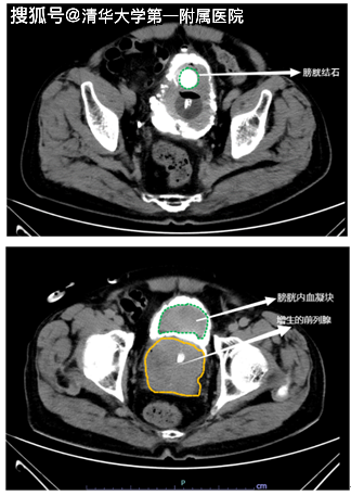 经泌尿系增强ct检查提示:膀胱结石,膀胱内血块,前列腺
