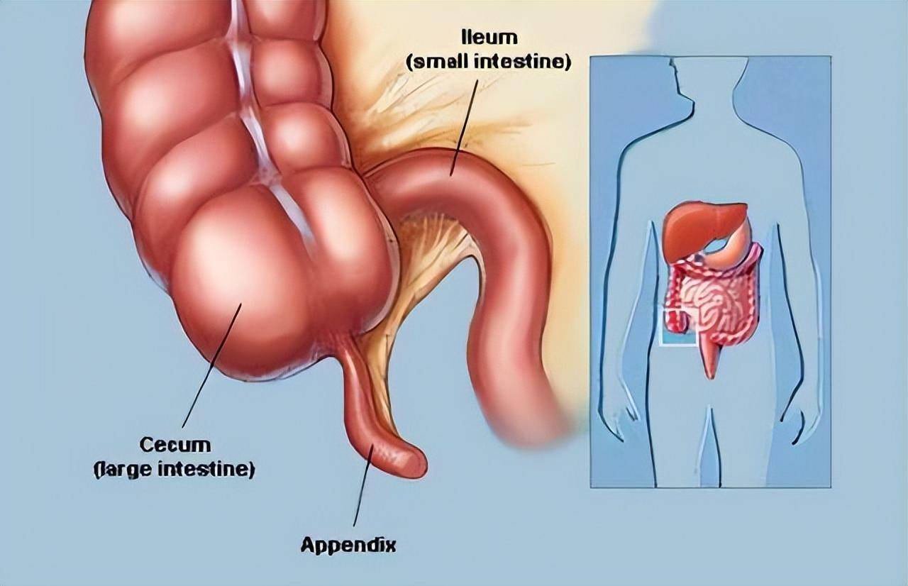 小儿阑尾炎是什么原因引起的症状表现有哪些(小孩阑尾炎怎么治疗好)
