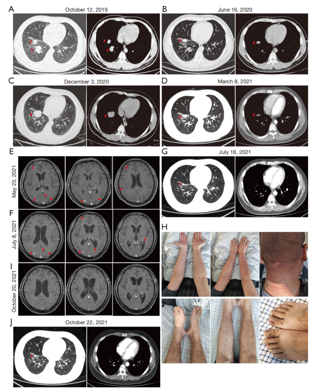 c797s顺式突变肺腺癌