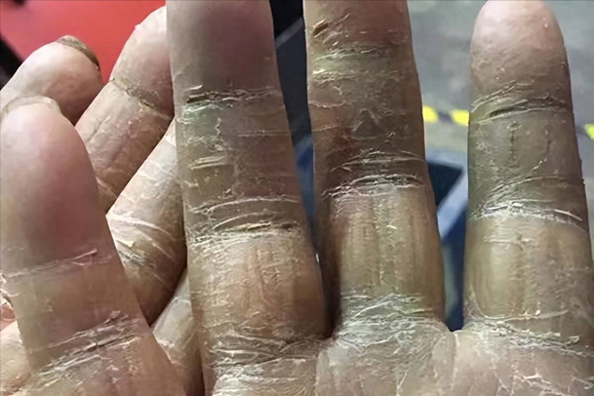 皮肤_裂口_状态