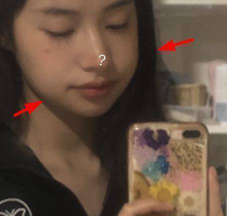 对比之前段小薇消瘦的脸部轮廓,如今脸肿了倒也增添