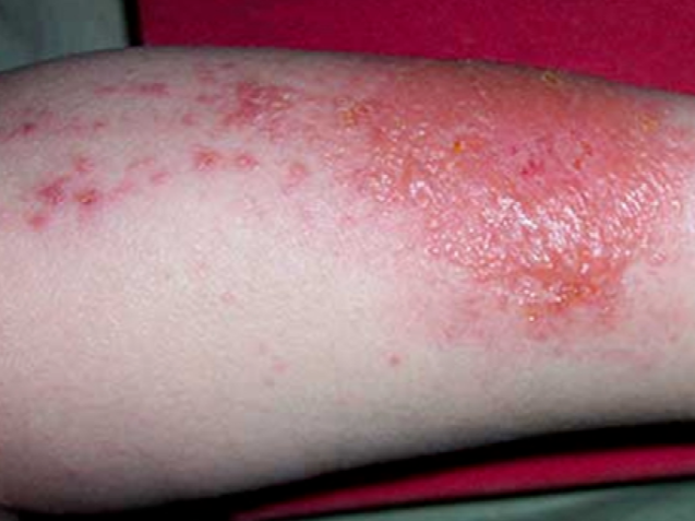 长沙鸿业皮肤医院:春季湿疹频繁发作,该怎么办?