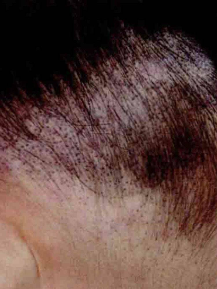 表现为头皮碟形污黄厚痂,中心有毛发贯穿,病发易折断,参差不齐,有鼠尿