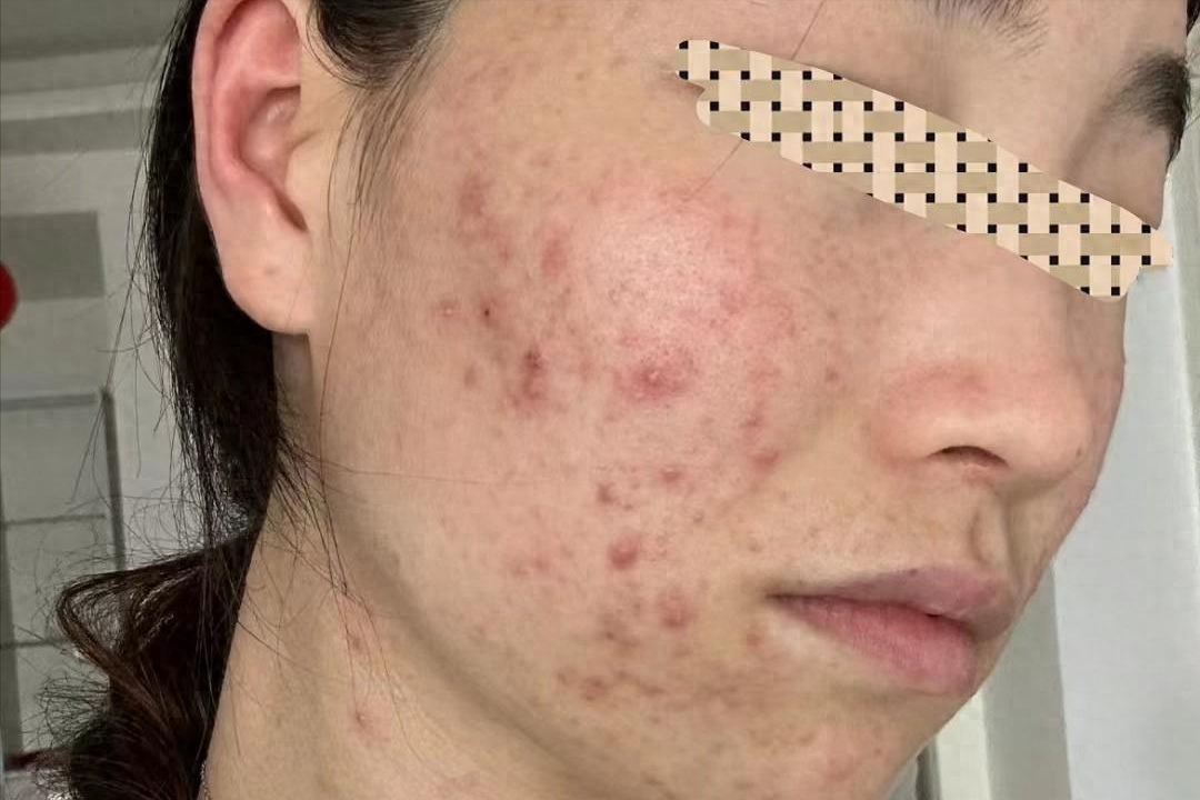 痤疮痘痘痘印竟然断根了!最快28天见效,关键每天只花三毛钱!