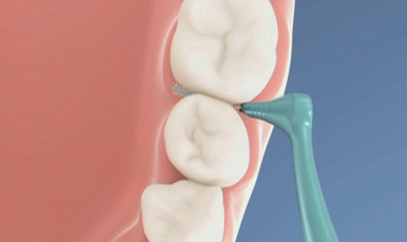春节过后,别忘了给牙齿"洗个澡"_牙龈_食物残渣_口腔
