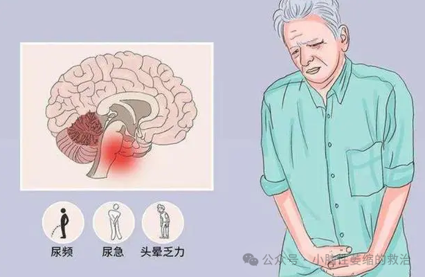 中药对小脑萎缩有效果吗?一篇文章带你揭秘!_患者_治疗_症状