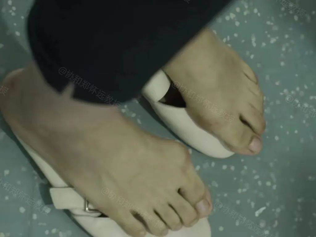 小姑娘患遗传拇外翻穿鞋疼 勇敢就医只为和"大脚骨"说拜拜_高跟鞋