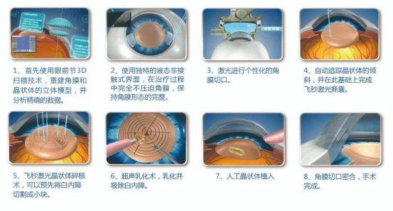 1,突破传统白内障手术的限制飞秒激光对晶状体脱位,悬韧带松弛,外伤性