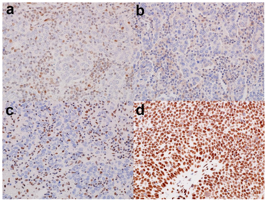 患者_病例_肿瘤