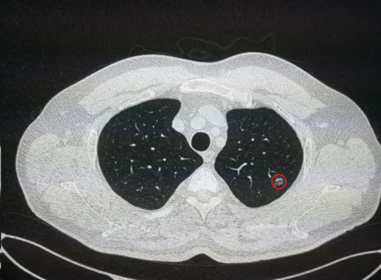 里面充斥着气体,如果用x光给肺部拍照的话,肺部在胸片和ct上显示都是