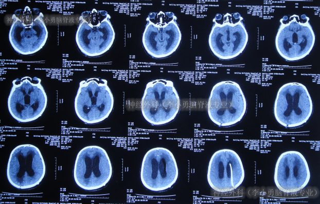 脑出血术后脑积水,脑室引流和脑分流术后反致运动不