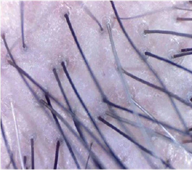 有植介:问题型头皮都有哪些?(一)_毛囊_原因_毛干