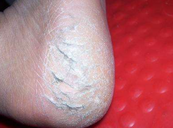 脚后跟干裂起皮不仅仅是缺乏维生素,或许还和这2大病症有关