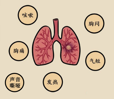 痰鸣音是什么声音 来自搜狐网