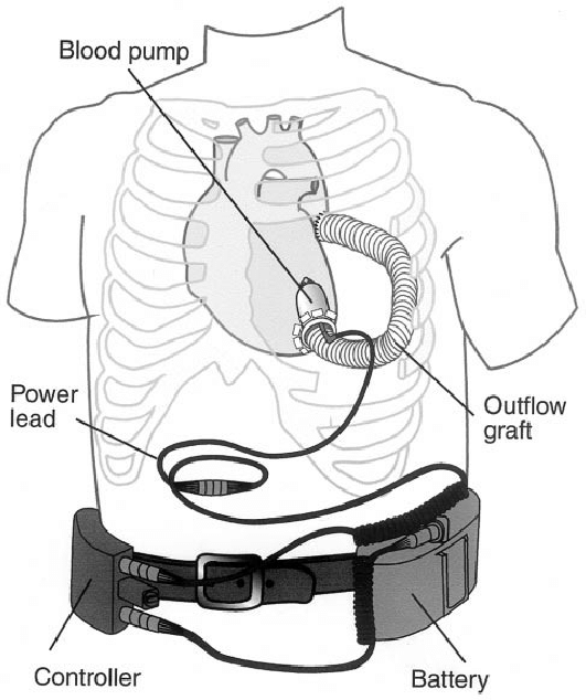 他没有心跳,没有脉搏,却跟正常人一样生活了七年_彼得·霍顿_心脏