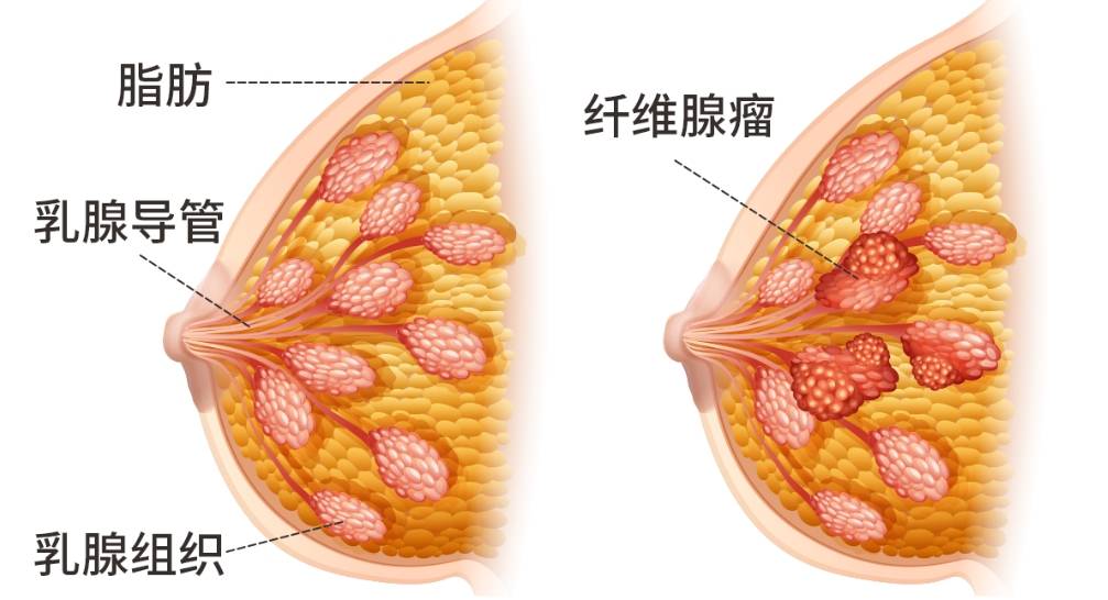 乳房有硬块怎么回事?