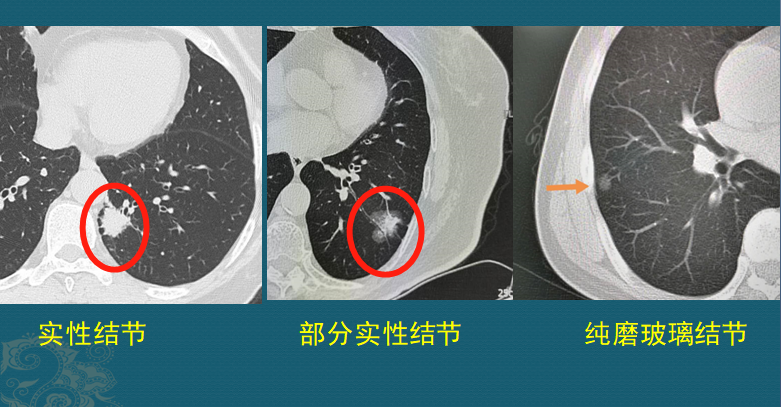 肺结节大小图片