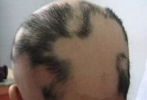 黑米3d纹发:平时掉头发都能长回来,秃顶了怎么就长不回来!