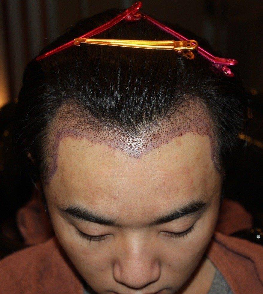 原创网友称华晨宇是自己老公还晒出多张华晨宇植发照片称张碧晨是小三