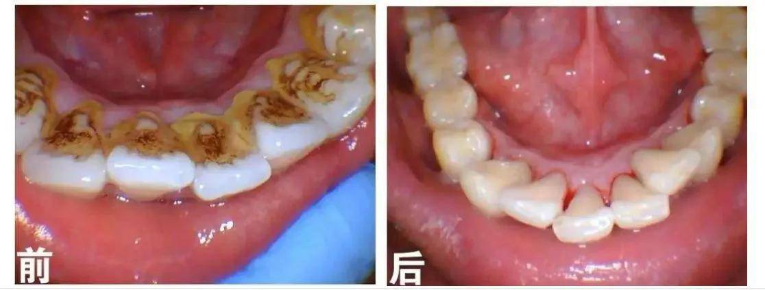 怎么去除牙结石 来自搜狐网