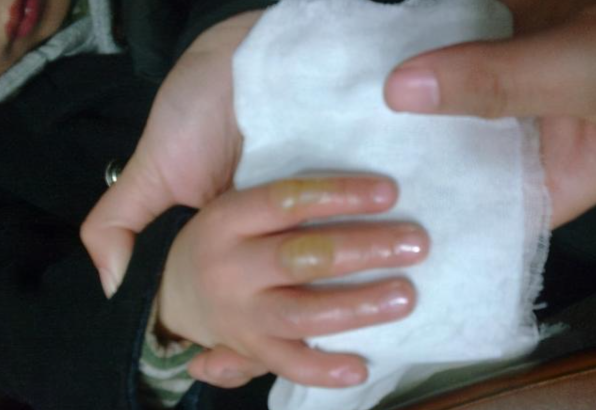 6岁孩子被开水烫伤,父母马上就医,医生怒斥:没常识害娃毁容