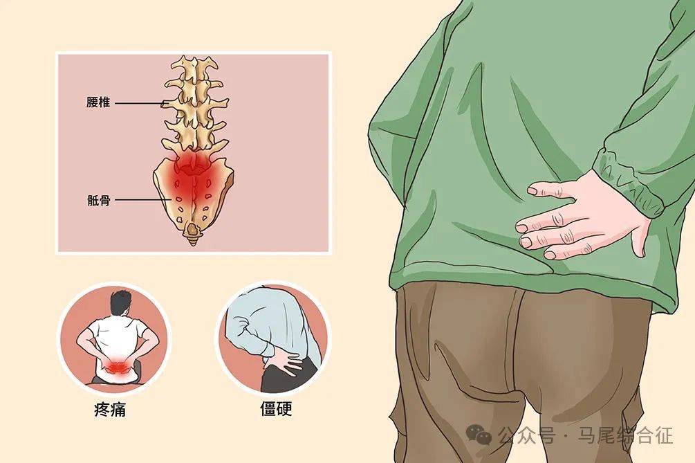 马尾神经损伤症状及对应治疗措施