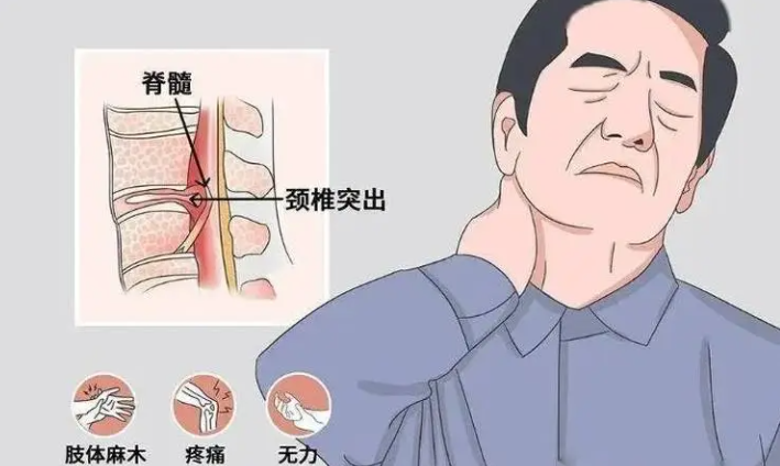 颈椎自然退变,可能会压迫椎间孔中的神经根,出现颈部疼痛症状