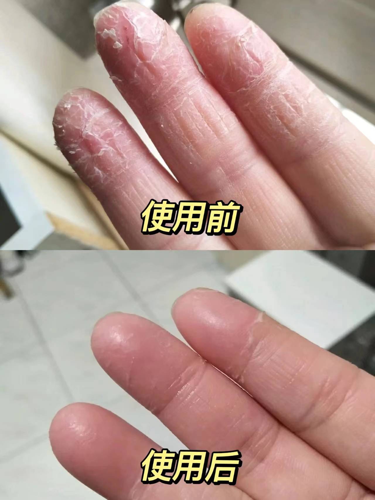 这个去裂法可别错过,手掌干裂3天解决!_皮肤_裂口_方法