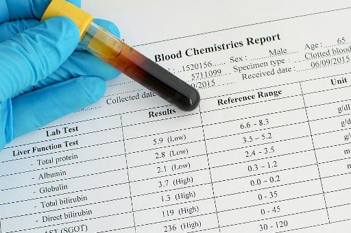 原创肝功能的检查包括哪些项目出现肝掌也不全有肝病