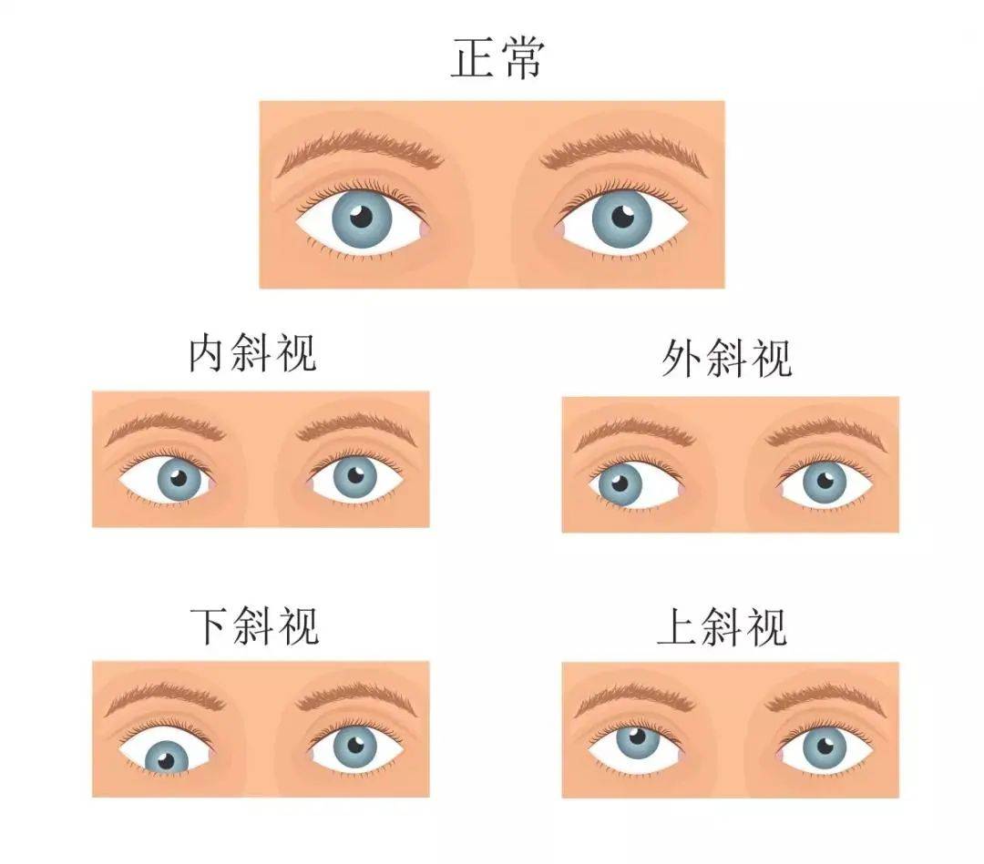 双眼近视度数相差大