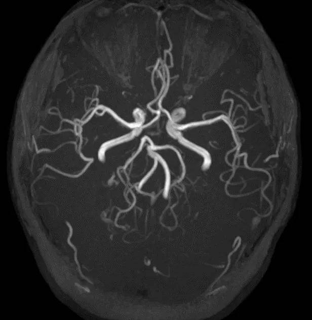 脑动脉瘤核磁共振图片图片