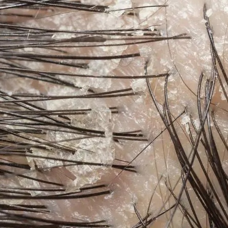 有植介:头皮养护的重要性,一定要知道._头发_问题_护理