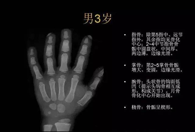 正常男女生骨龄图谱家长可对照观察