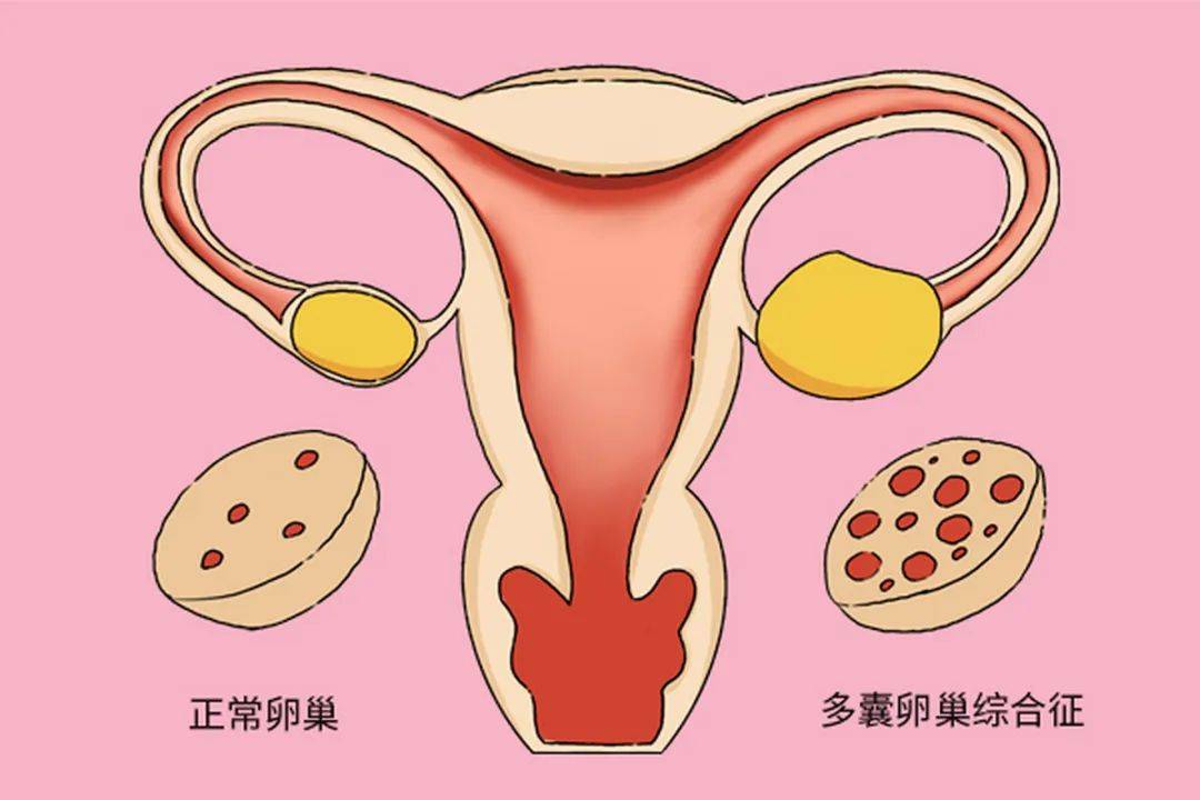 多囊卵巢综合征的危险因素有哪些?该如何治疗呢?