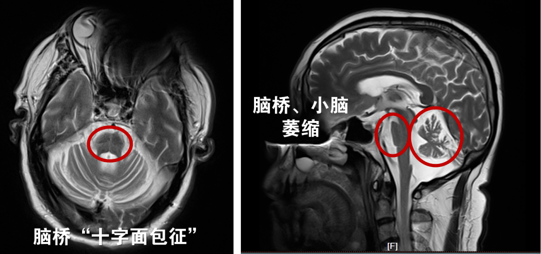 多系统萎缩被分为几个类型,又该如何进行治疗呢?