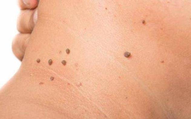 年龄的增长,皮肤逐渐失去弹性,变得松弛,而此时,往往会出现一些小肉粒