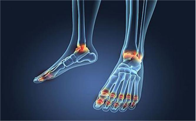 养成这4个习惯,痛风离你远远的_尿酸_关节_运动