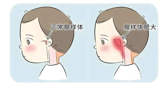 鼻炎腺样体肥大高发季节你的鼻子还好吗