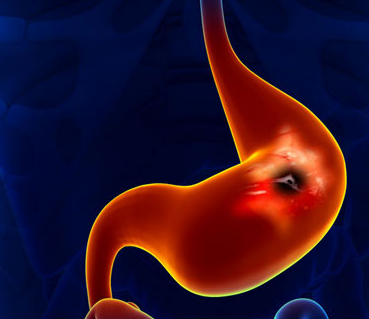 胃溃疡为什么那么难治愈吃什么对胃溃疡痊愈有帮助呢