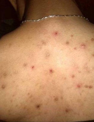 原创前胸后背长满痘痘都是湿气重惹的祸