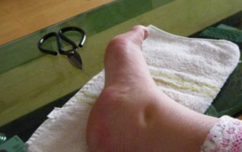 原创怀孕时出现大象腿你那可能不是胖而是孕期水肿