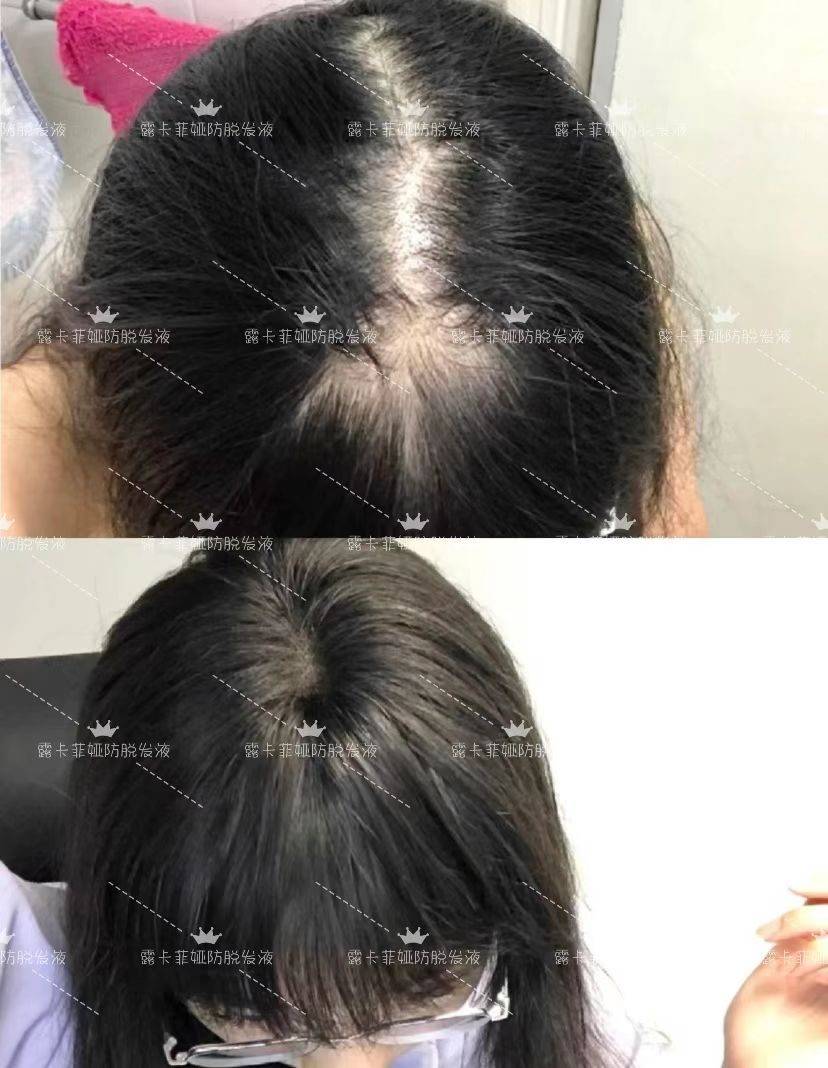 防脱产品排行榜分享_头皮_效果_头发