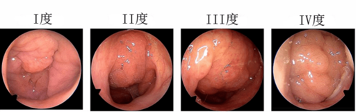 需要医生结合临床判断:① 有阻塞性睡眠呼吸暂停表现,同时扁桃体增大