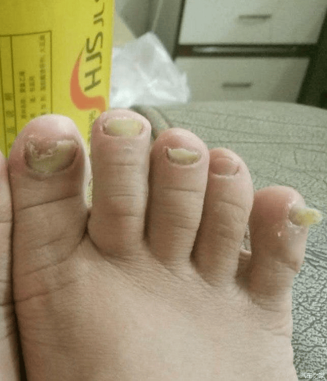 硬核去灰指甲的方法赶紧学用完灰甲直接蹭蹭掉