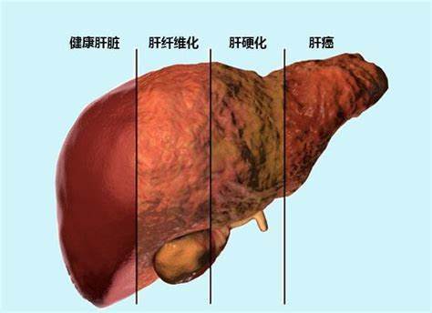 乙肝大三阳发作会引起什么症状